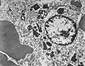 M,58y. | spleen - thesaurismosis of unknown origin … postmedicamentous?